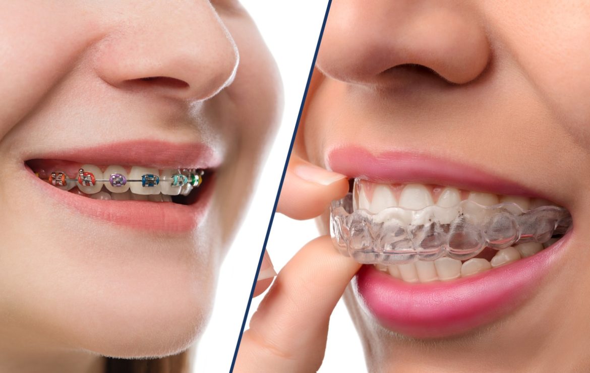 Braces vs. Invisalign for Teens: Which Is Better in 2026?